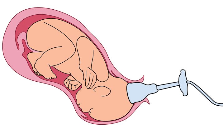 vacuum-assisted delivery childbirth for first time mothers