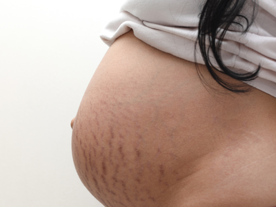stretch marks on pregnant belly