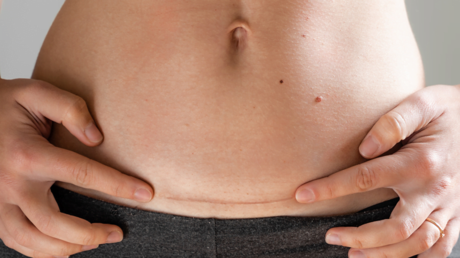 Tips Merawat Bekas Jahitan Caesar