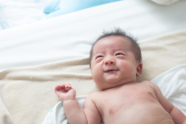 Cara Mencegah Kulit Bayi Mengelupas