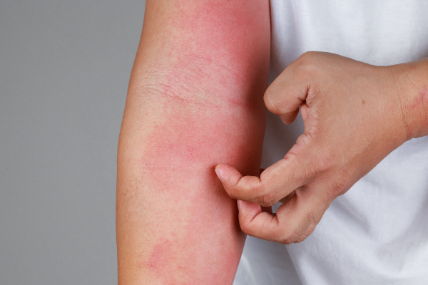 Tisu Basah Bayi bisa Menyebabkan Alergi Kulit