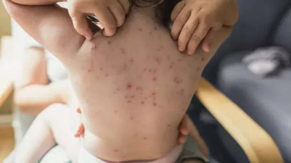 Infeksi Virus