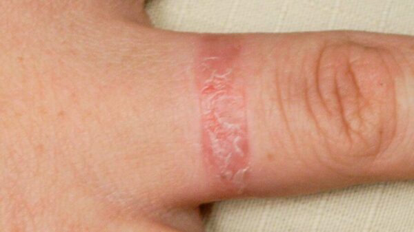 Dermatitis Kontak