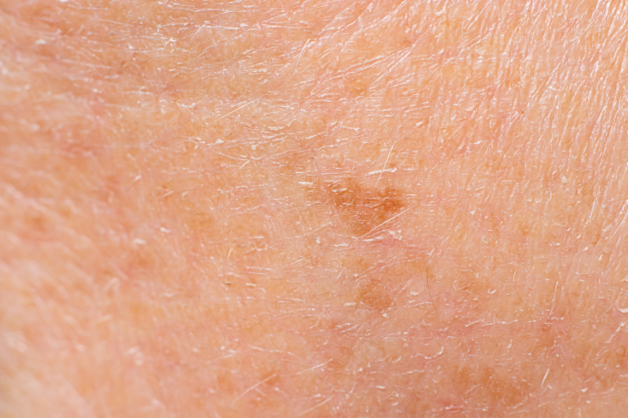 Apakah Melasma Bisa Hilang