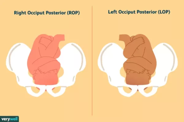 posisi posterior oksiput atau cephalic 