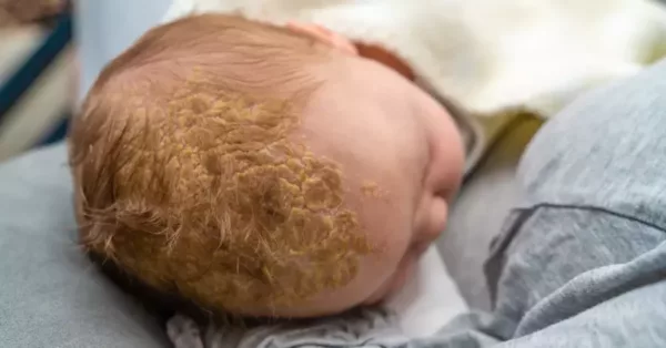 5 penyebab rambut bayi rontok