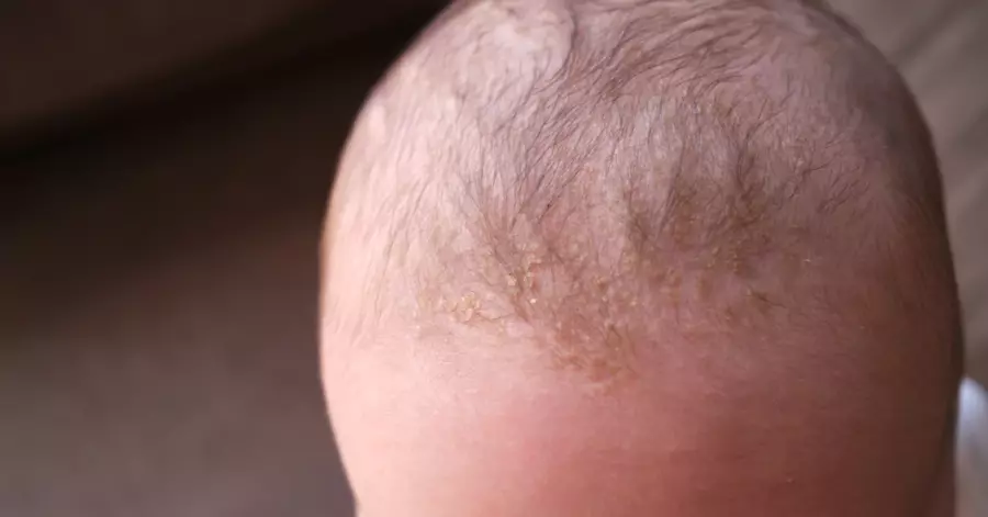 Penyebab Rambut Rontok pada Bayi: 12 Faktor yang Perlu Diketahui Orang Tua