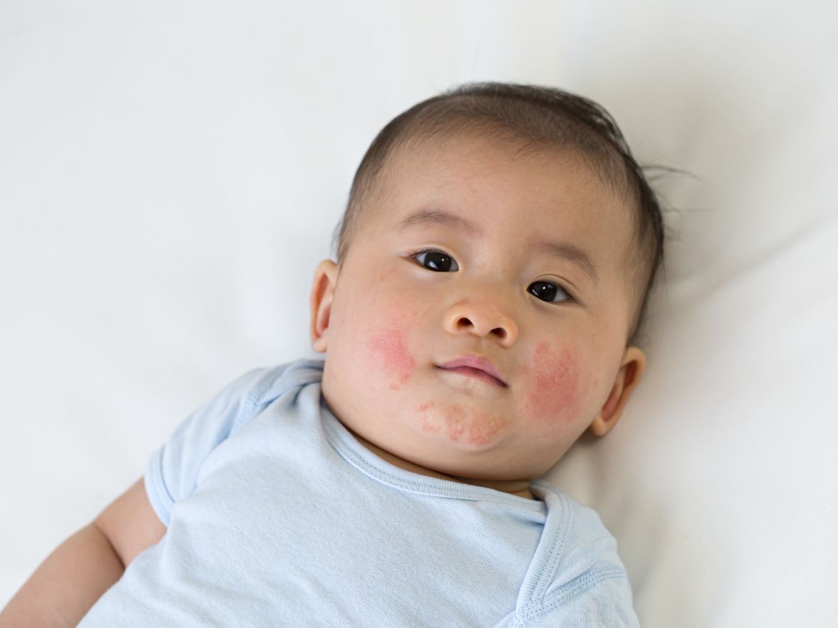 trẻ sơ sinh bị nổi mẩn đỏ ở mặt