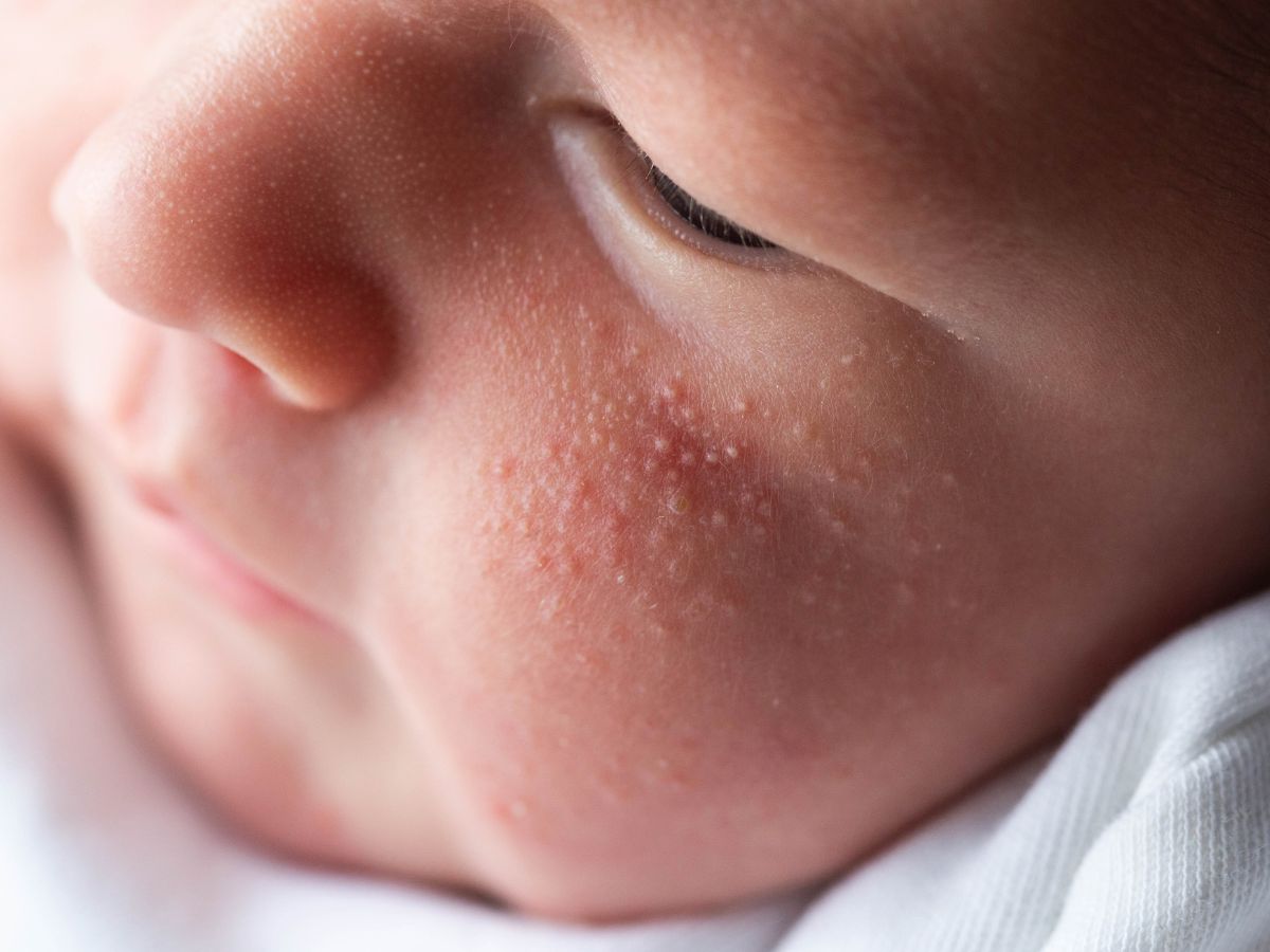 trẻ sơ sinh bị nổi mẩn đỏ ở mặt